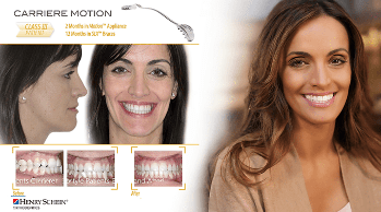 Girl before and after Reveal Aligners